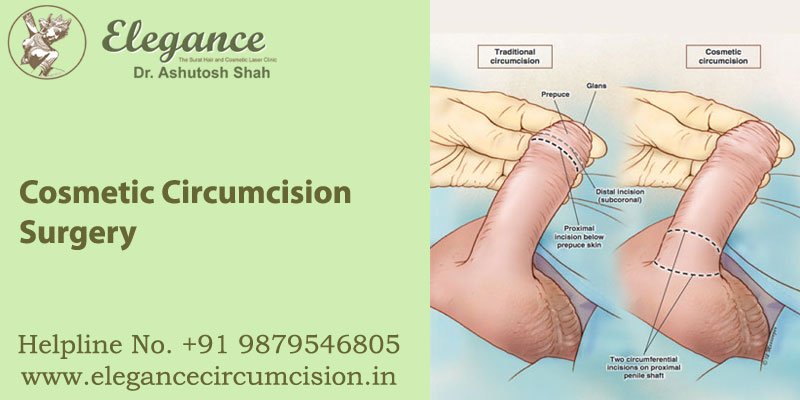 https://www.elegancecircumcision.in/