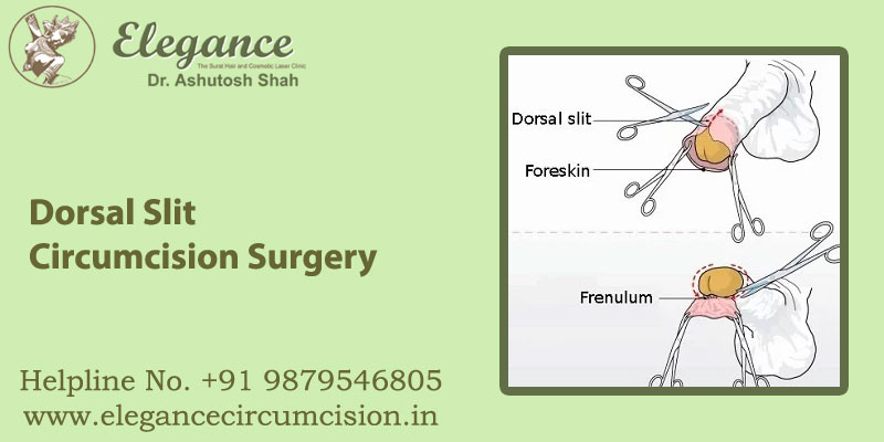 Dorsal Slit Circumcision Surgery