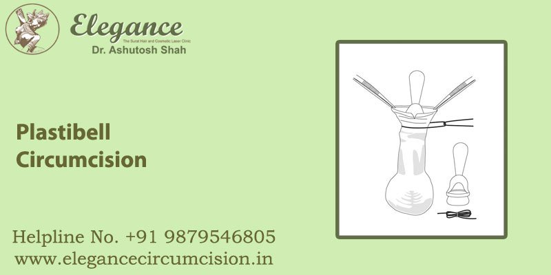 Plastibell Circumcision in surat