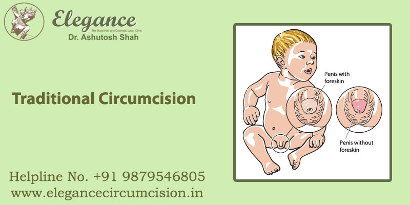 Traditional Circumcision in surat