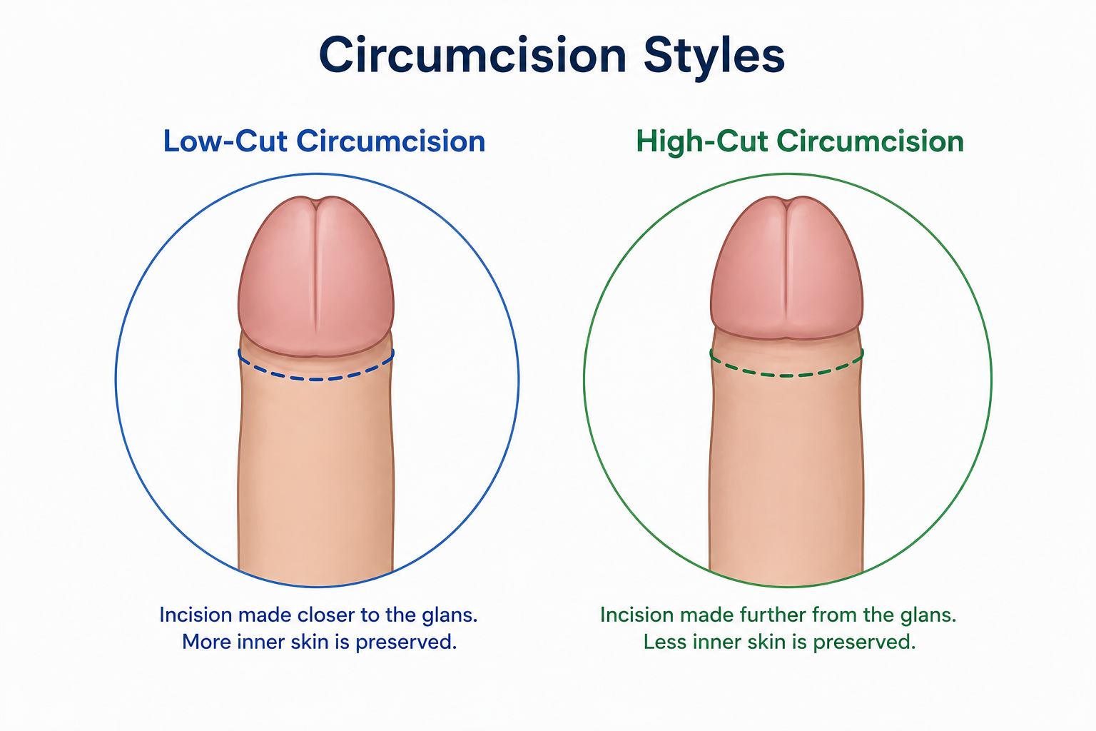 Why Do Some Men Choose Low-Cut Circumcision?