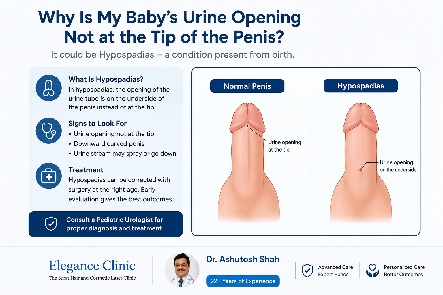 Why Is My Baby's Urine Opening Not at the Tip of the Penis?